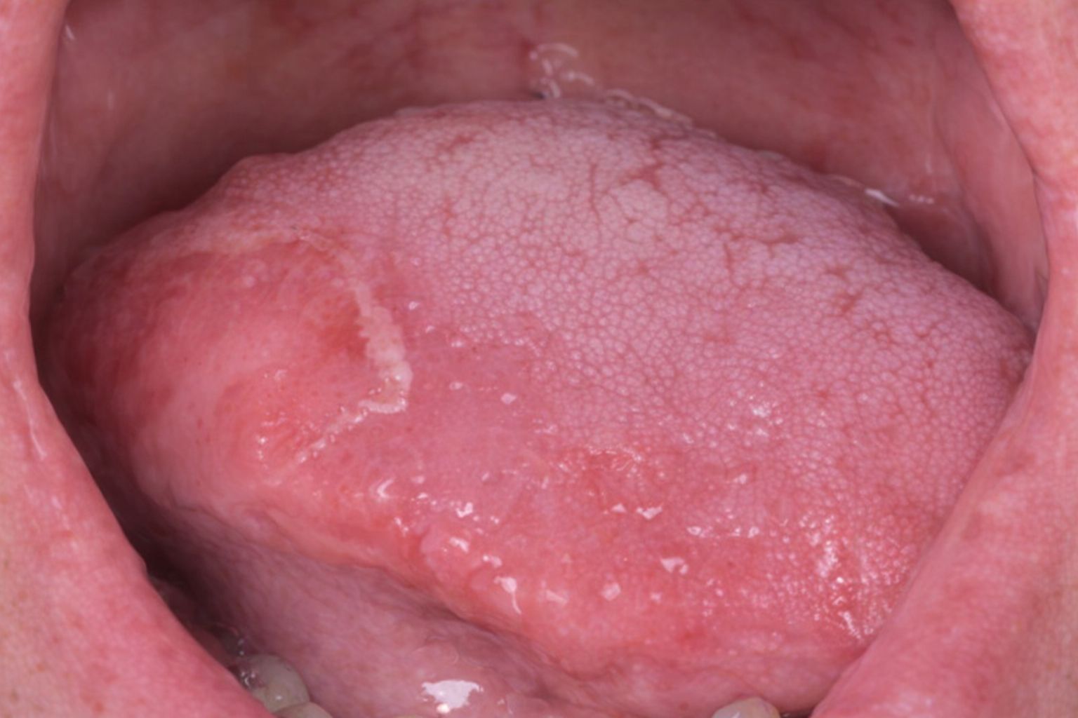 Nærbilde av en tunge med de karakteristiske flekkene til geografisk tunge.